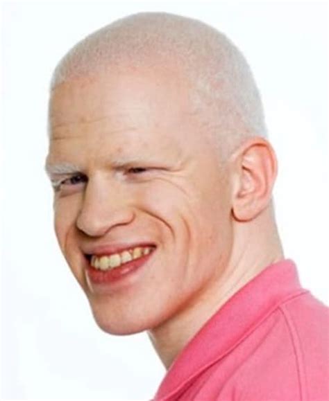 Famous Albino People You Should Know