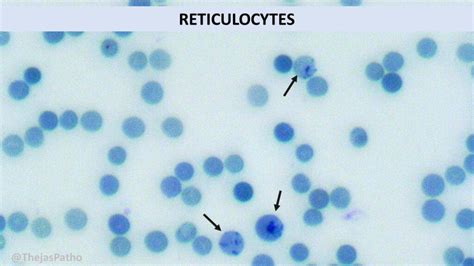 RETICULOCYTE COUNT Pathology Made Simple