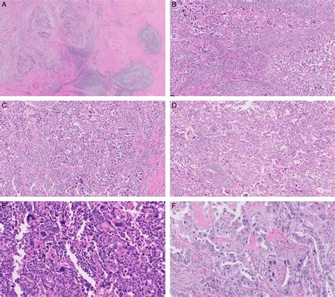 American Journal Of Surgical Pathology：特定的病理学特征丰富了用于极点测试的子宫内膜癌的选择 Medsci Cn