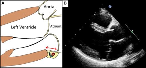 Ventricular Arrhythmias In Mitral Valve Prolapse New Explanations For ...