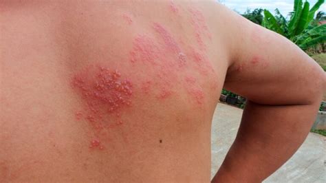 How To Identify A Shingles Rash On The Back Dermatomes Chart And Map