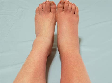 Cellulitis Infection Foot