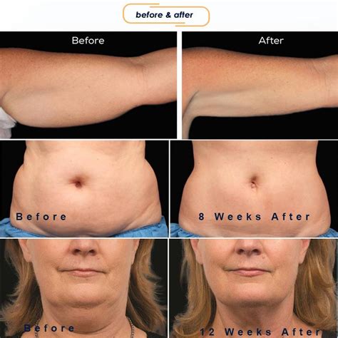 Velashape Before And After Vivalaser For You For All For Beauty