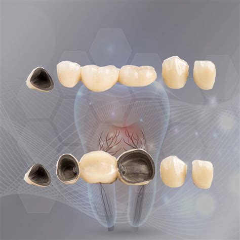 Pr Tesis Dental Metal Porcelana Porcelana Fundida Sobre Metal