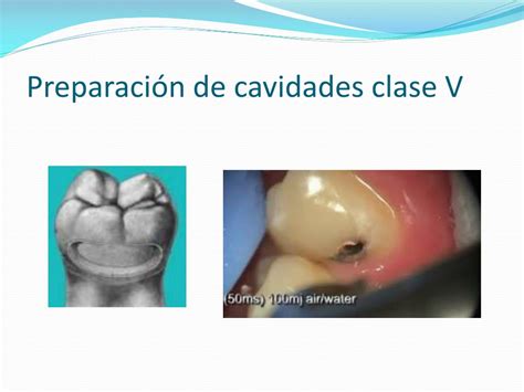 Ppt Conceptos Basicos De Cavidades Dentales Powerpoint Presentation