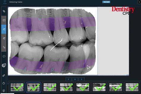 Dentistry Cpd Detecting Periodontal Disease With Ai