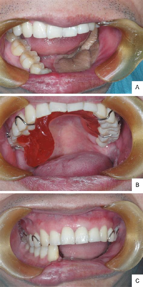 Figure 3 From En Block Resection Of A Giant Gingival Malignant Melanoma