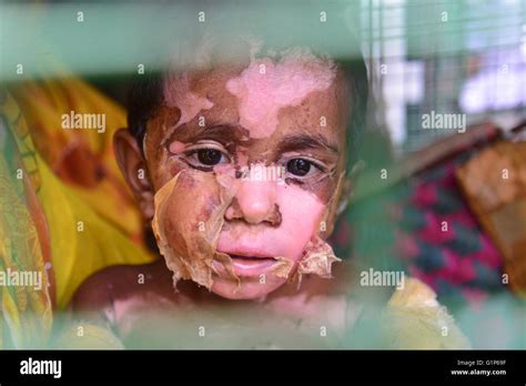 Dhaka Bangladesh 18th May 2016 Tamanna 4 Years Old A Burn Child