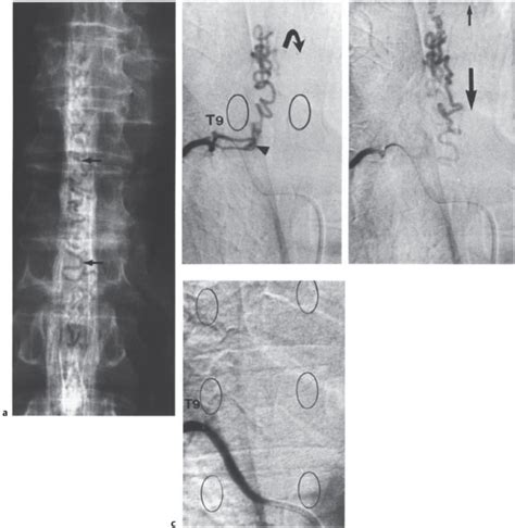 Endovascular Therapy And Other Minimally Invasive Treatments For Spinal