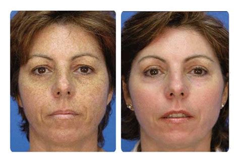 Microsdermabrasion Before And After Inskin