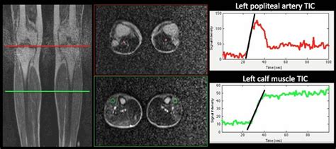 Mr Based Calf Muscle Perfusion Index Correlates With Treadmill Exercise