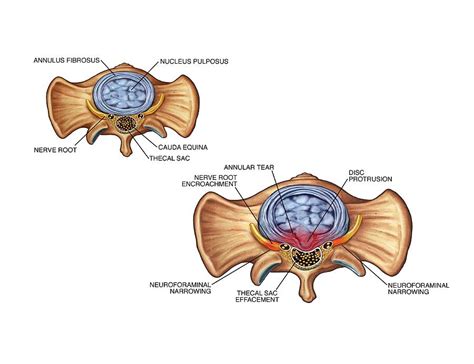 Annular Tear Of Intervertebral Disc Photograph By John T Alesi