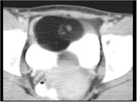 How Dermoid Cysts Are Formed Dermoid Cysts Formation Symptoms