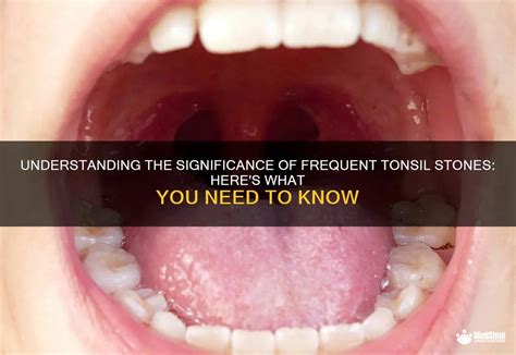 Understanding The Significance Of Frequent Tonsil Stones Here S What