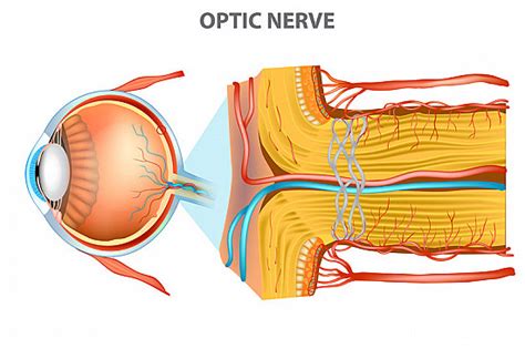 Optic Nerve Swelling (Papilledema) - Harvard Health