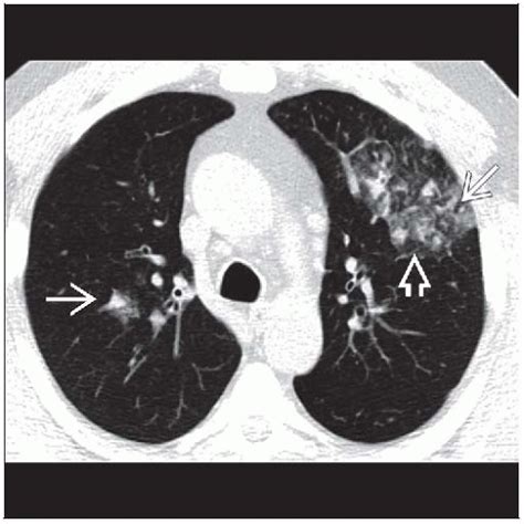 Viral Pneumonia Radiology Key