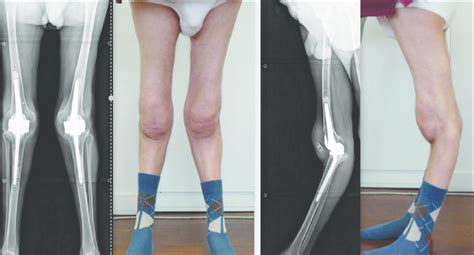 Postoperative Anteroposterior A And Lateral C Radiographs And