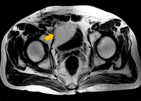 There Was No Residual Lipoma Around Right Inguinal Region On