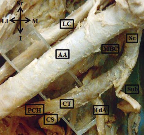 Posterior circumflex humeral, anterior circumflex humeral and profunda ...