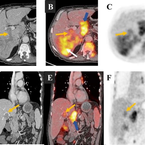 A 47 Year Old Male Patient With Liver Cirrhosis And Subtotal Benign