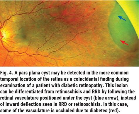 Cystoid Degeneration Retina