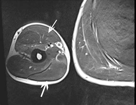 Figure 3 From Ultrasound Diagnostic And Physiotherapy Approach For A