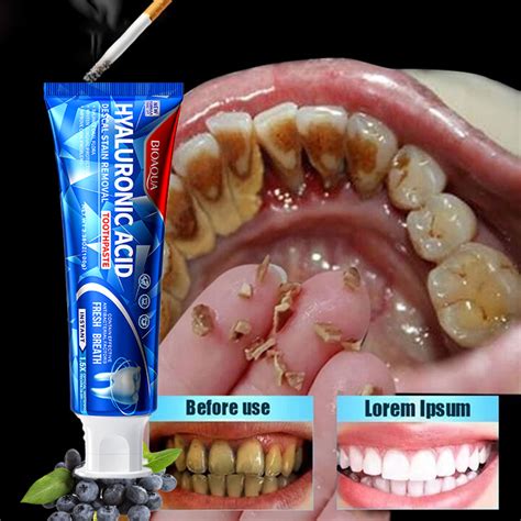 Pemutih Gigi Halal Kuning Teeth Whitening Products Bodyaid