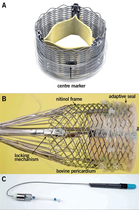 Transfemoral Aortic Valve Replacement With The Repositionable Lotus