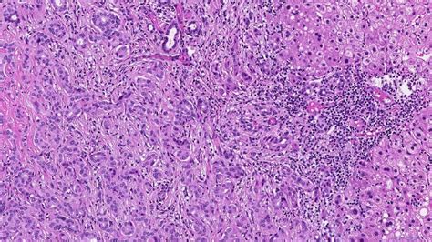 Bile Duct Adenoma Ottawa Atlas Of Pathology