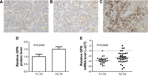 Expression Levels Of Opn In Nsclc Tissue Notes A Ihc Staining Of