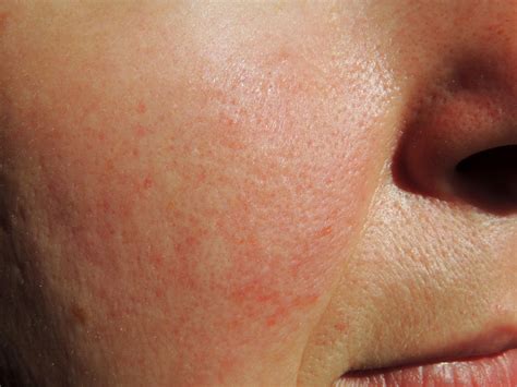 Rosacea Treatment in Hagerstown, Maryland