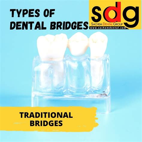 Traditional Dental Bridge - Sachem Dental Group