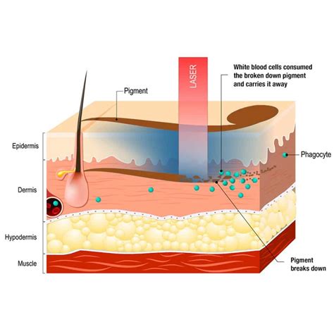 Pico Rejuvenation Even Skin Tone In Fewer Treatments Pico