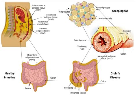 Jpm Free Full Text Creeping Fat In Crohns Disease—surgical