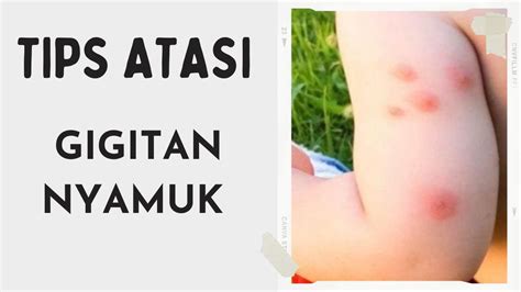 Cara Menghilangkan Bekas Gigitan Nyamuk Yang Menghitam Pada Anak Bayi