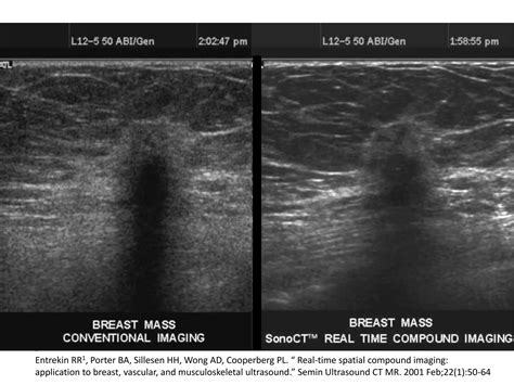 Reverberation Artifacts In Ultrasound Imaging Ppt