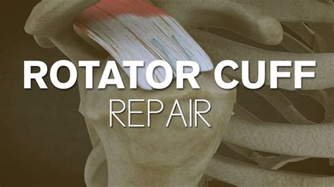 What happens during a rotator cuff surgery? | Rotator cuff surgery, Rotator cuff, Rotator cuff ...