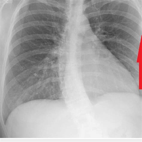 Anterior Posterior Radiograph Pre Surgery Show Normal Download Scientific Diagram