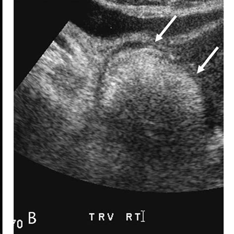 Color Doppler Image Of The Right Ovary Demonstrates The Typical Ring