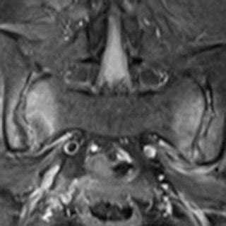 Resonancia Magn Tica En Secuencia T Que Muestra Edema Periarticular De