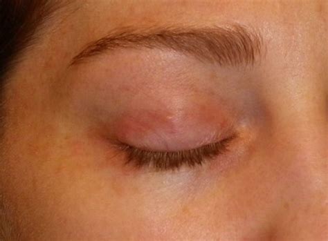 Rash On Eyelid Medical Point