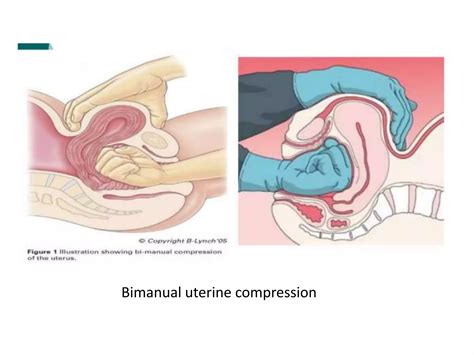 Post Partum Hemorrhage Pph Ppt