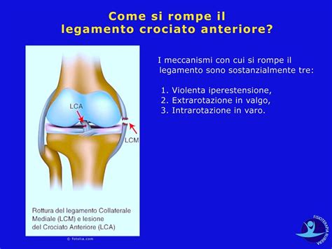 Rottura Del Legamento Crociato Ant Del Ginocchio I Sintomi E Cosa Fare