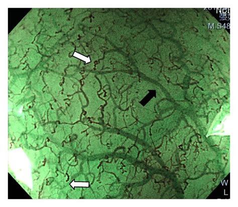 Magnifying Endoscopy With Narrow Band Imaging Of Intestinal Metaplasia Download Scientific