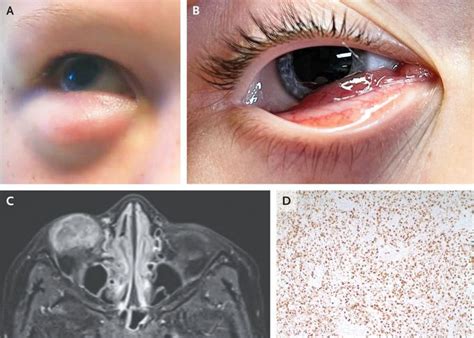 Orbital Rhabdomyosarcoma Medizzy