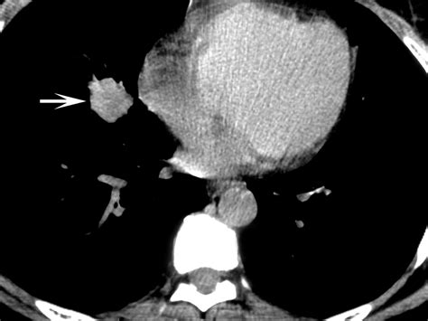 Lymphoepithelioma Like Carcinoma Of The Lung Radiologic Features Of An