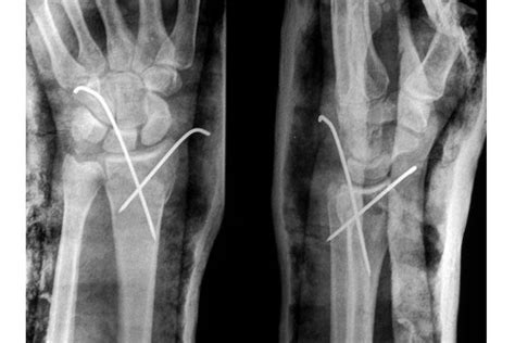 Fractura De Mu Eca O Radio Distal Tratamiento Conservador O Cirug A