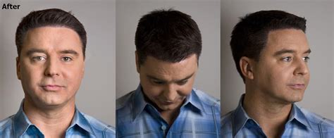 Hairline Lowering Procedure Alvi Armani Hair Transplant Los Angeles