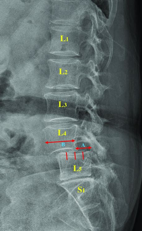 Lumbar Spondylolisthesis L Lumbar Vertebra S Sacral Vertebra A