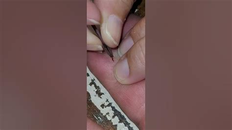 Deep Splinter Removal Youtube